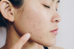 痤疮的中医治疗方法如何