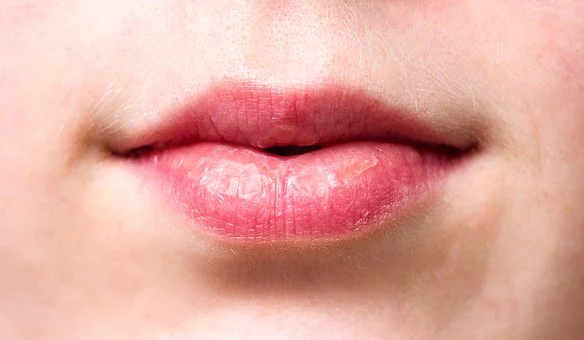 注射玻尿酸丰唇有哪些优势