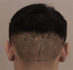 头发种植提取毛囊