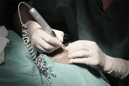 头发种植微针提取毛囊