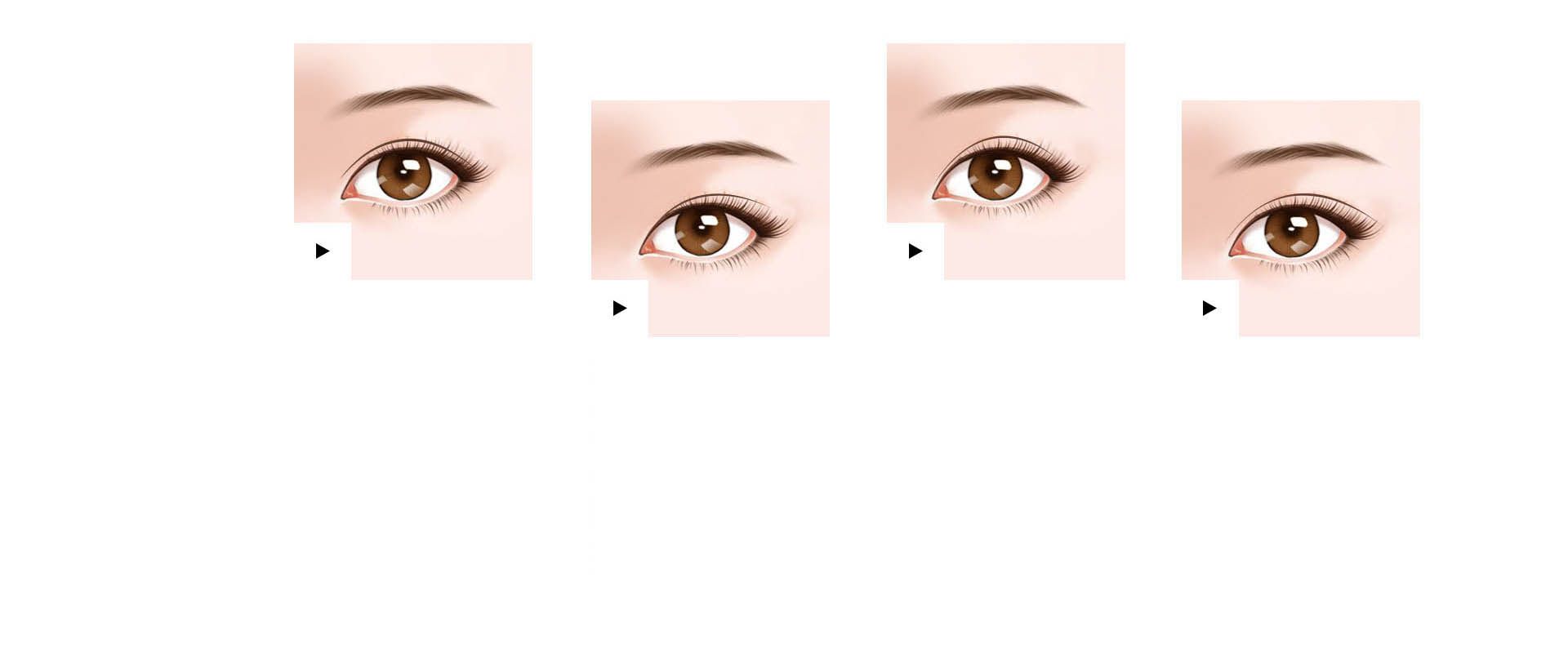 眼部整形双眼皮类型