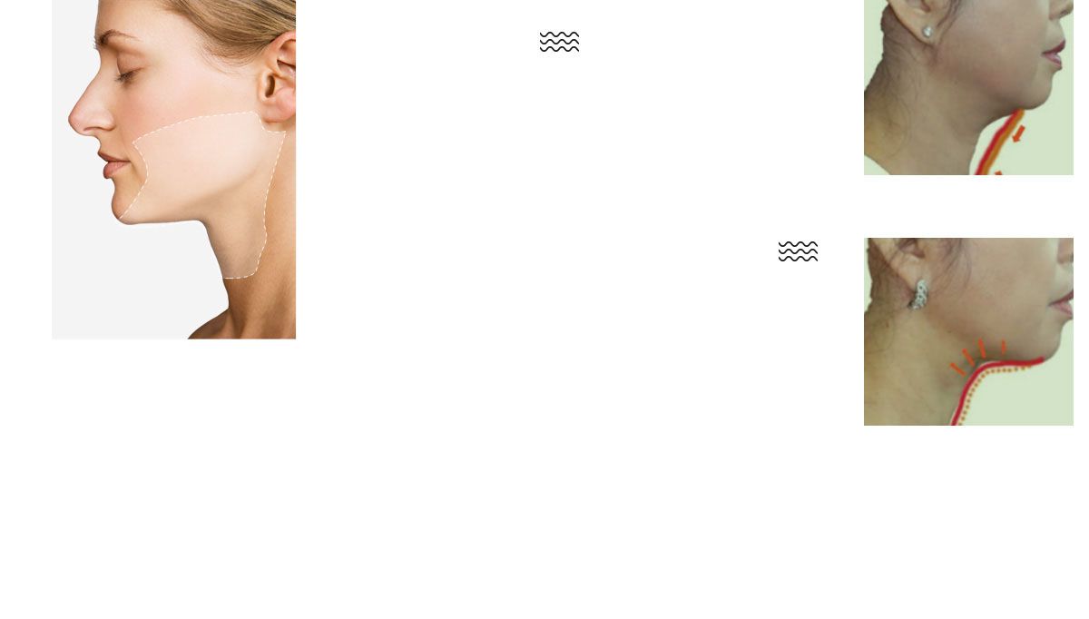 颈部整形注射范围