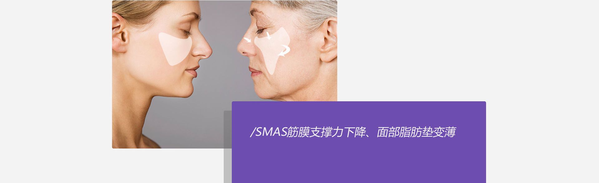 线雕解决面部软组织下垂的根本原因