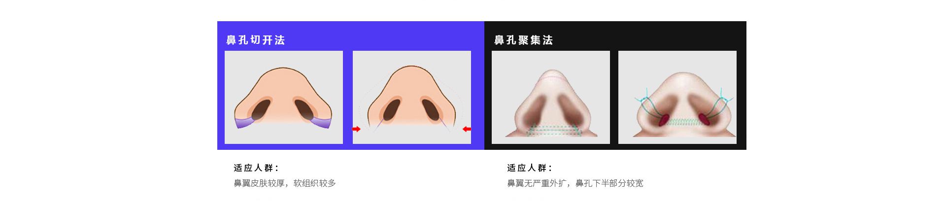 鼻部整形怎么做